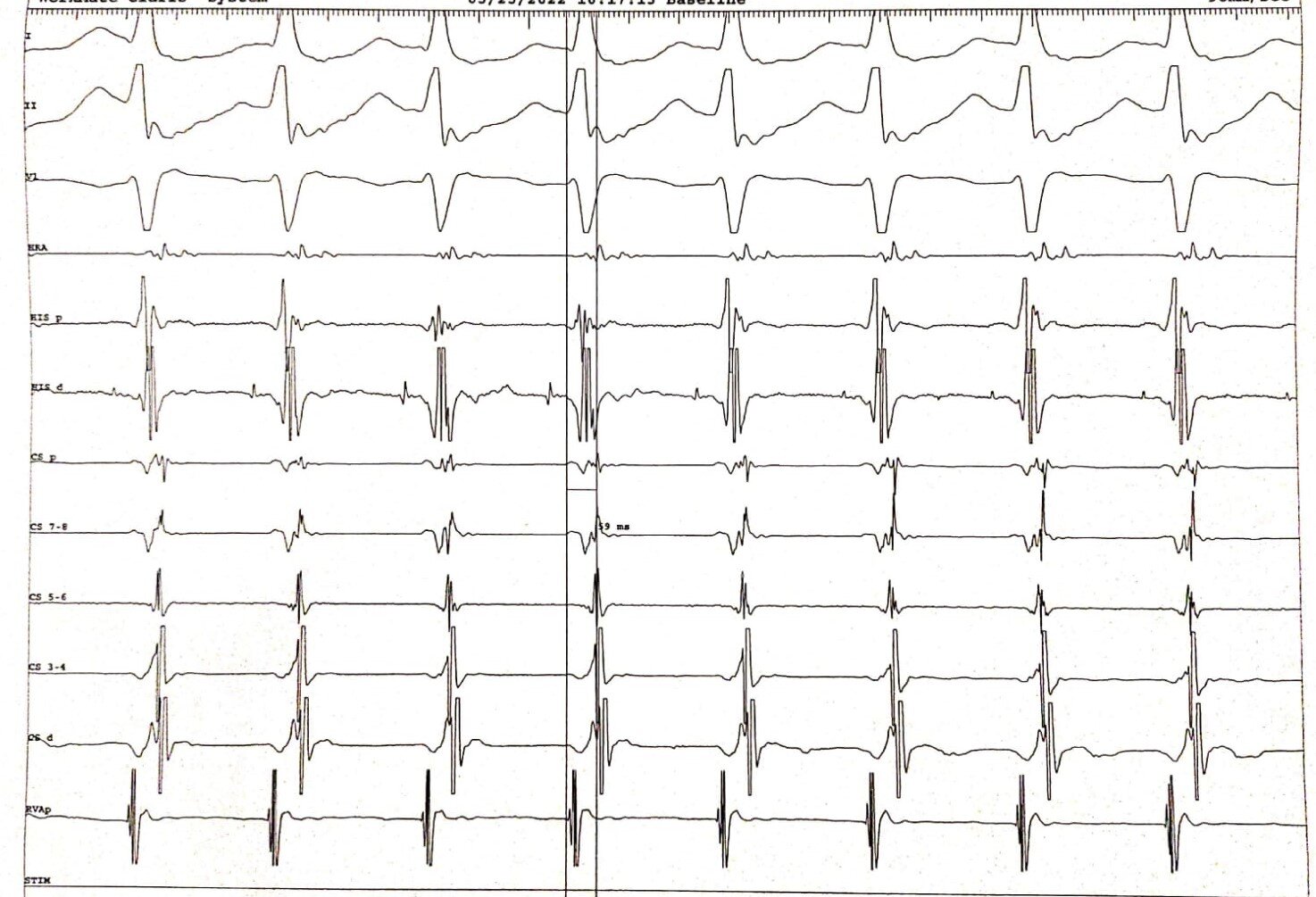 <p>Narrow Complex Tachycardia: Short Ventriculoatrial Interval