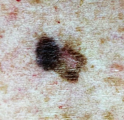 Asymmetrical, irregular borders, heterogenous color, 7 mm pigmented lesion; suspicious of melanoma