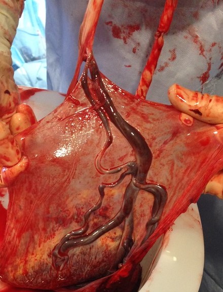 <p>Velamentous Cord Insertion