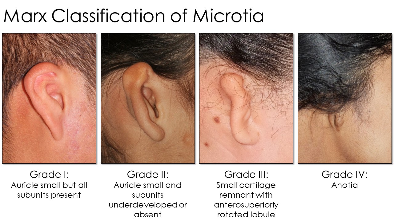 <p>Marx Classification of Microtia