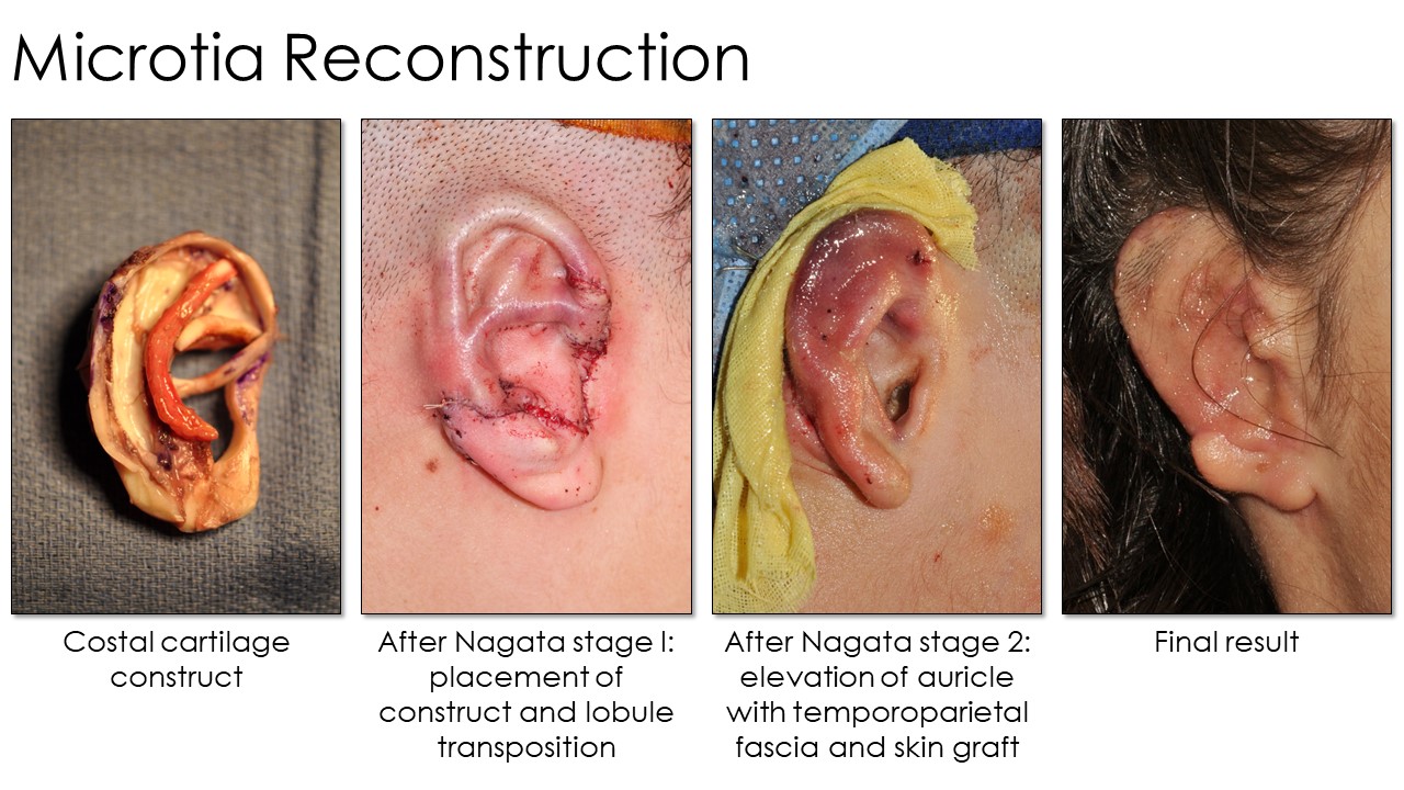 <p>Microtia Reconstruction. This series of images shows the Nagata microtia reconstruction stages.</p>