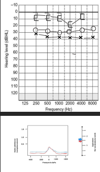 <p>Audiometric and Tympanometric Findings in Otosclerosis