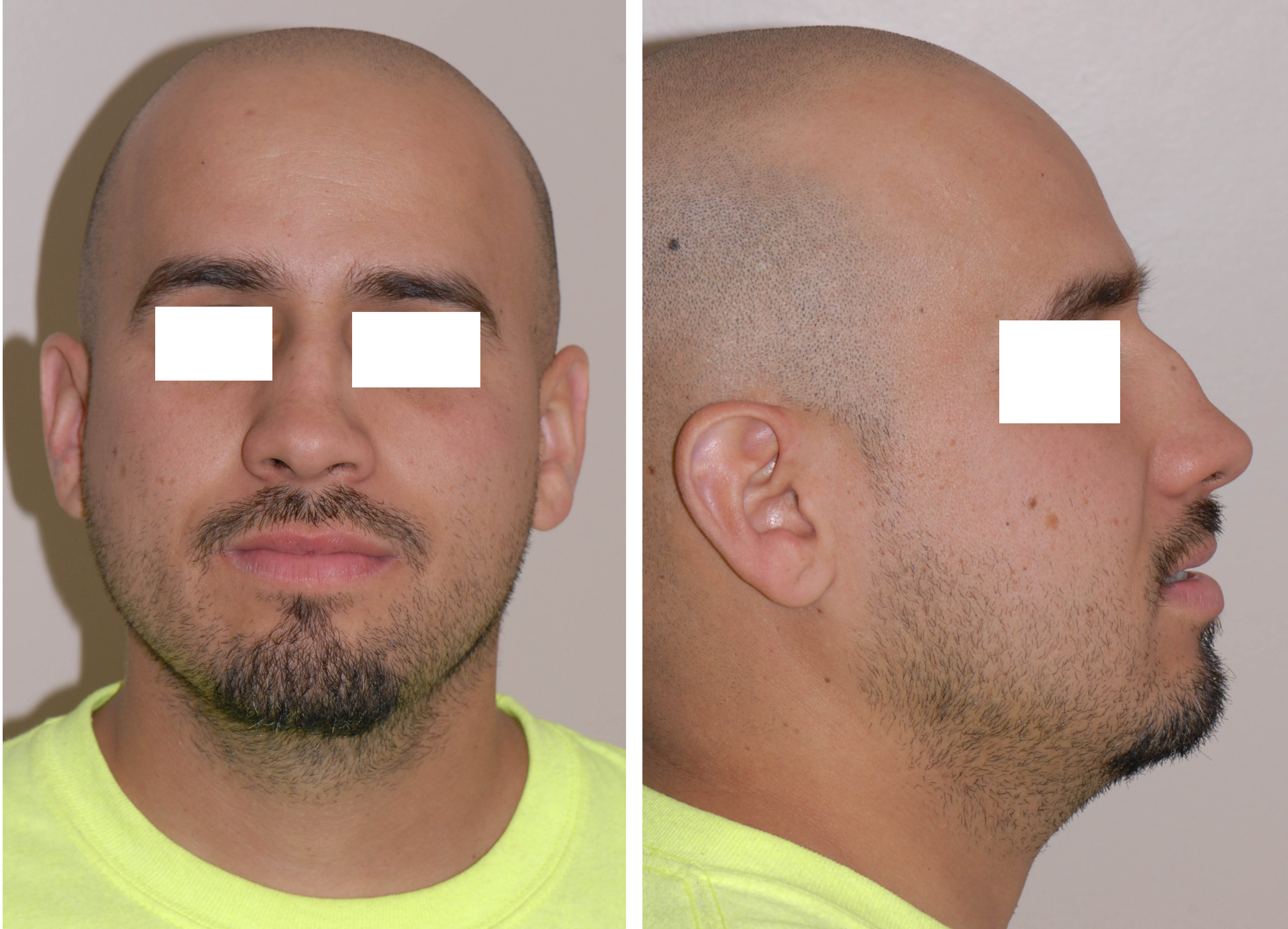 <p>Saddle Nose Deformity.</p>
