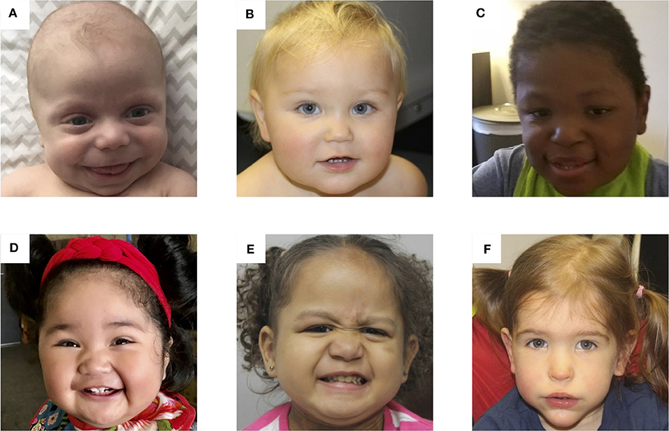 <p>Patients With BWS