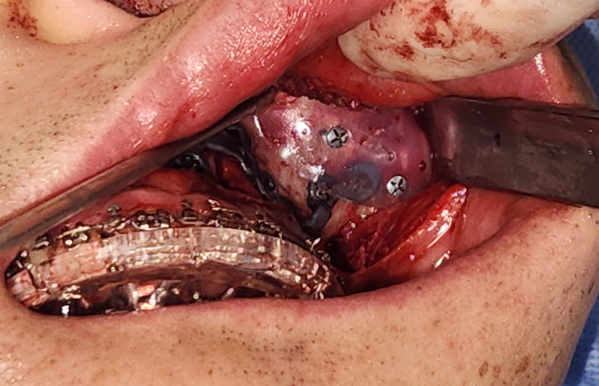 <p>Malar Implant. This image shows the insertion of a malar implant via an intraoral incision.</p>