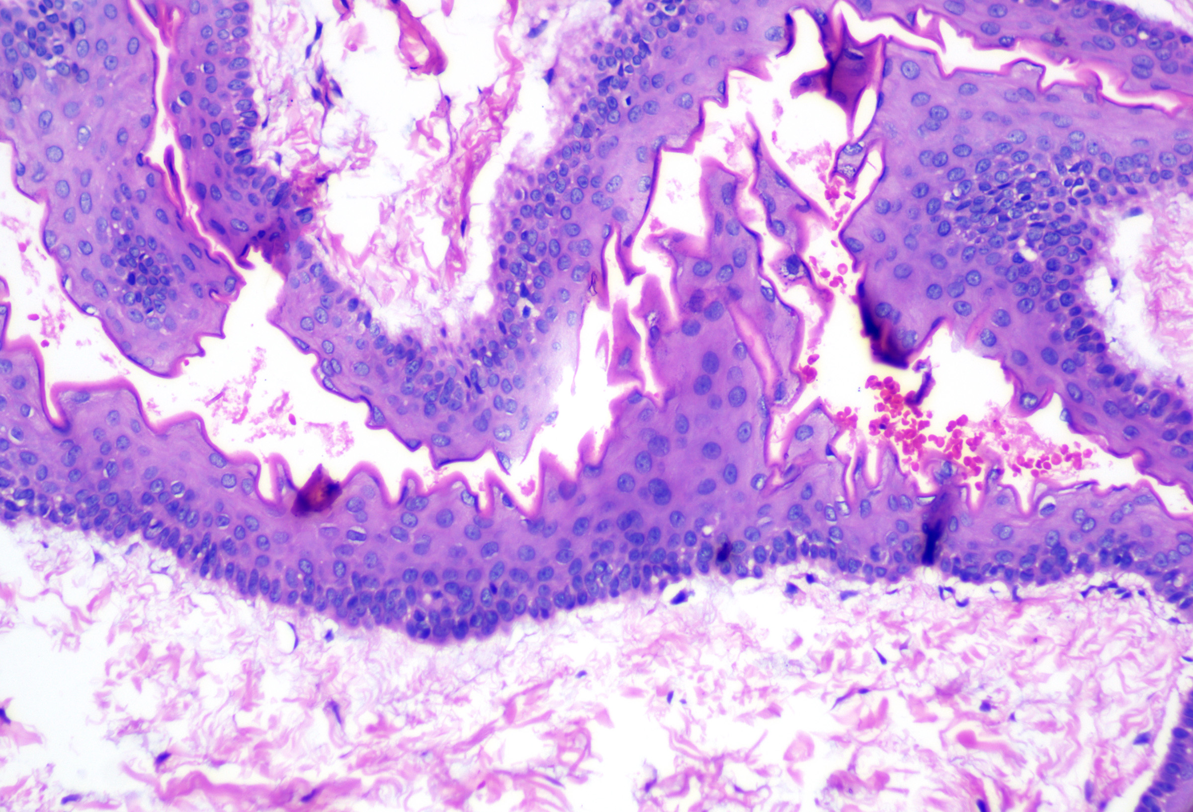 <p>Histopathology of Steatocystoma