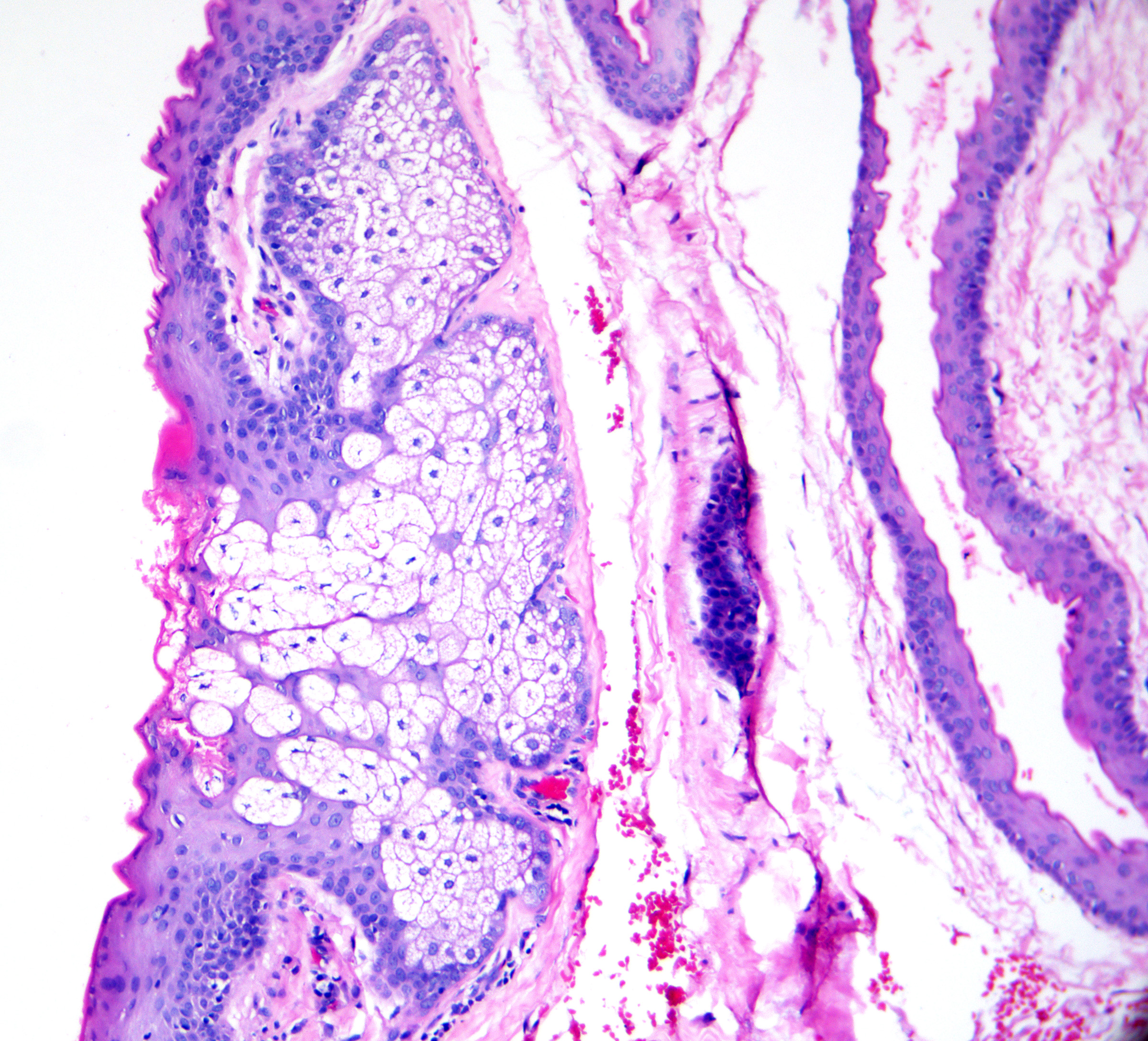 <p>Histopathology of Steatocystoma Cuticle