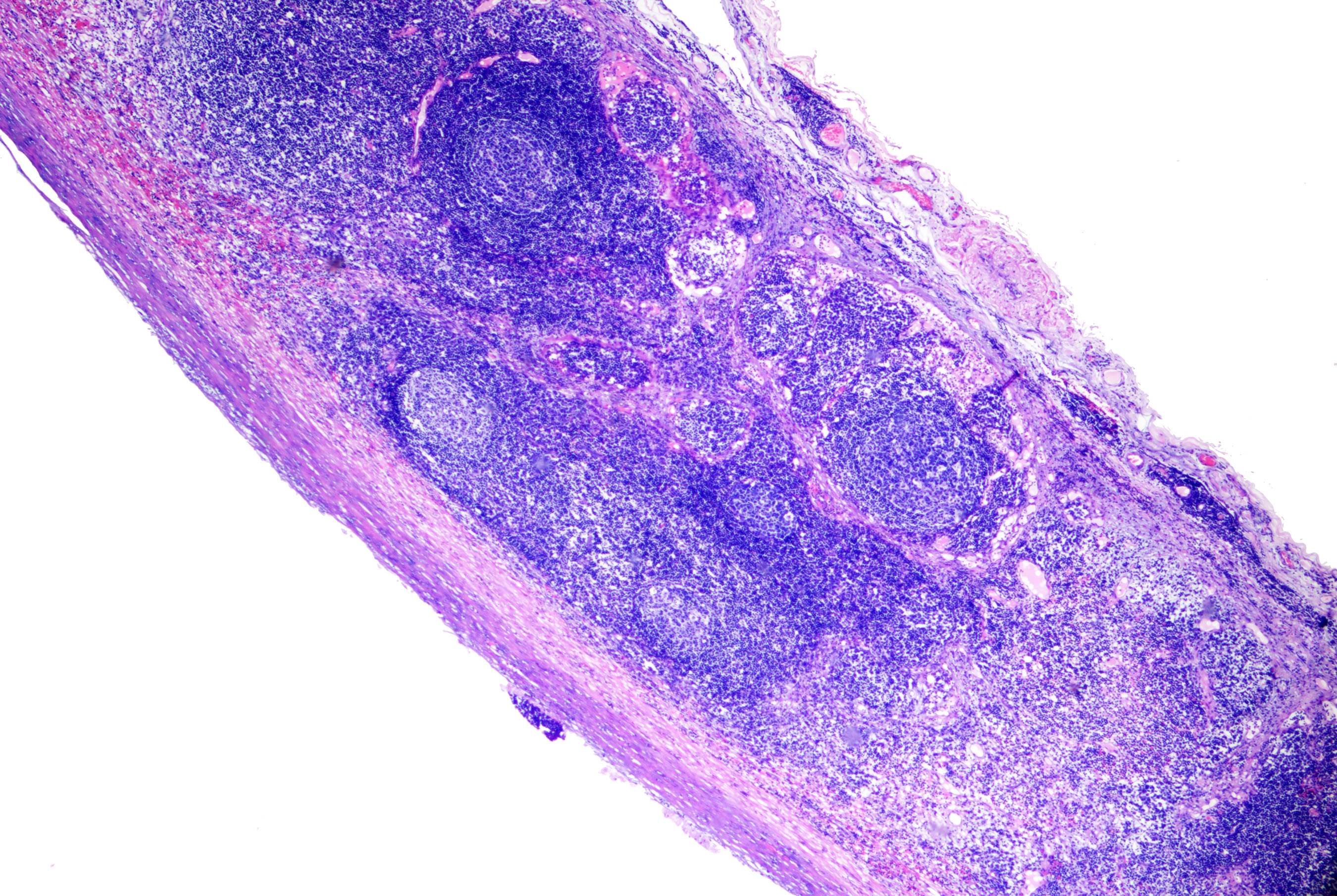 <p>Branchial Cyst on Histopathology