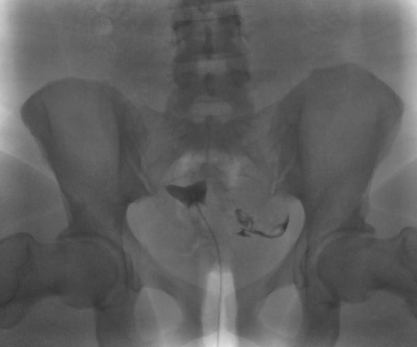 <p>Right Fallopian Tube Occlusion