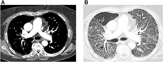 <p>Pulmonary Hypertension From Connective Tissue Disease on CT