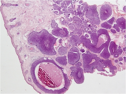 <p>Basal Cell Carcinoma on Cheek&mdash;H&amp;E Staining Showing Basaloid Islands.</p>