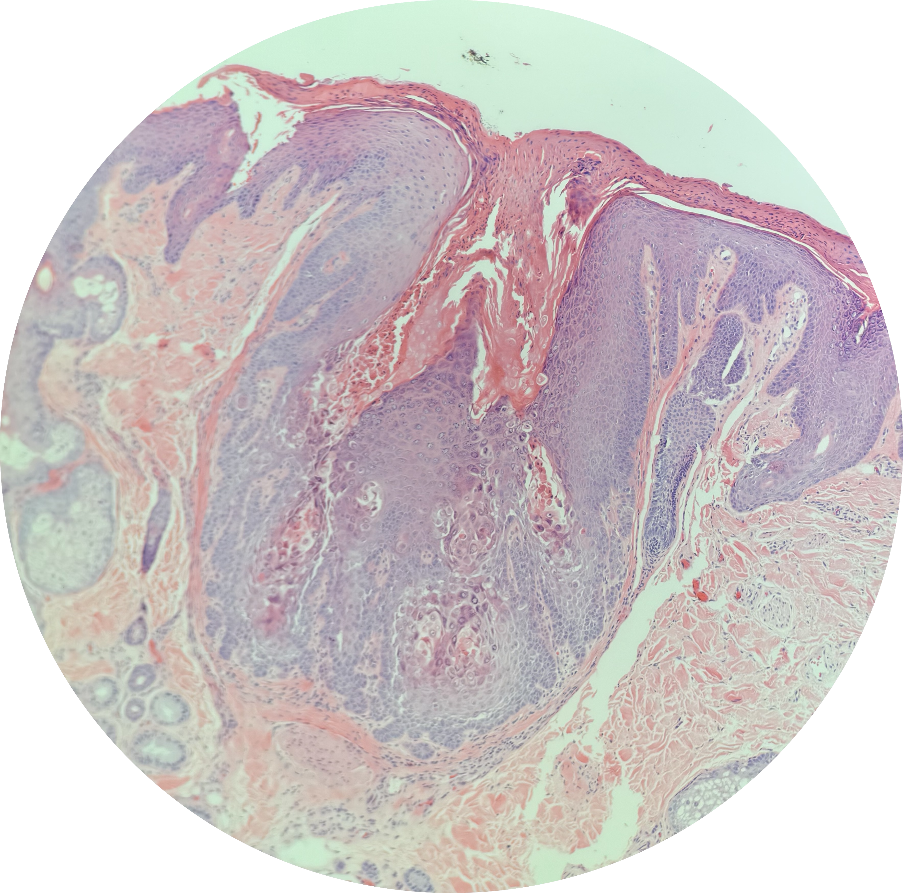 <p>Warty Dyskeratoma Pathology Architecture</p>