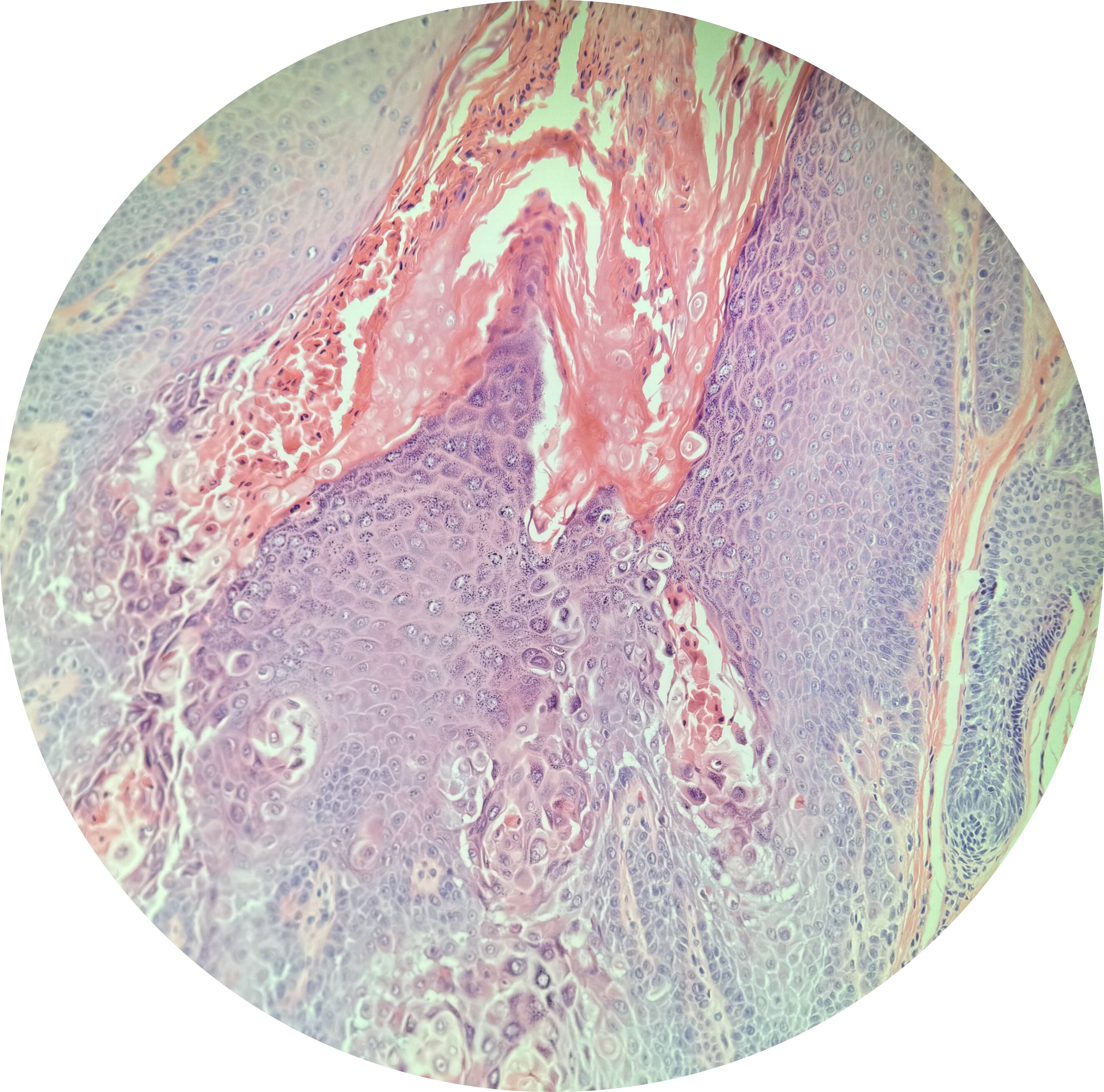 <p>Warty Dyskeratoma Pathology Corps Ronds and Grains</p>