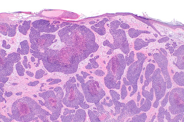 <p>Porocarcinoma