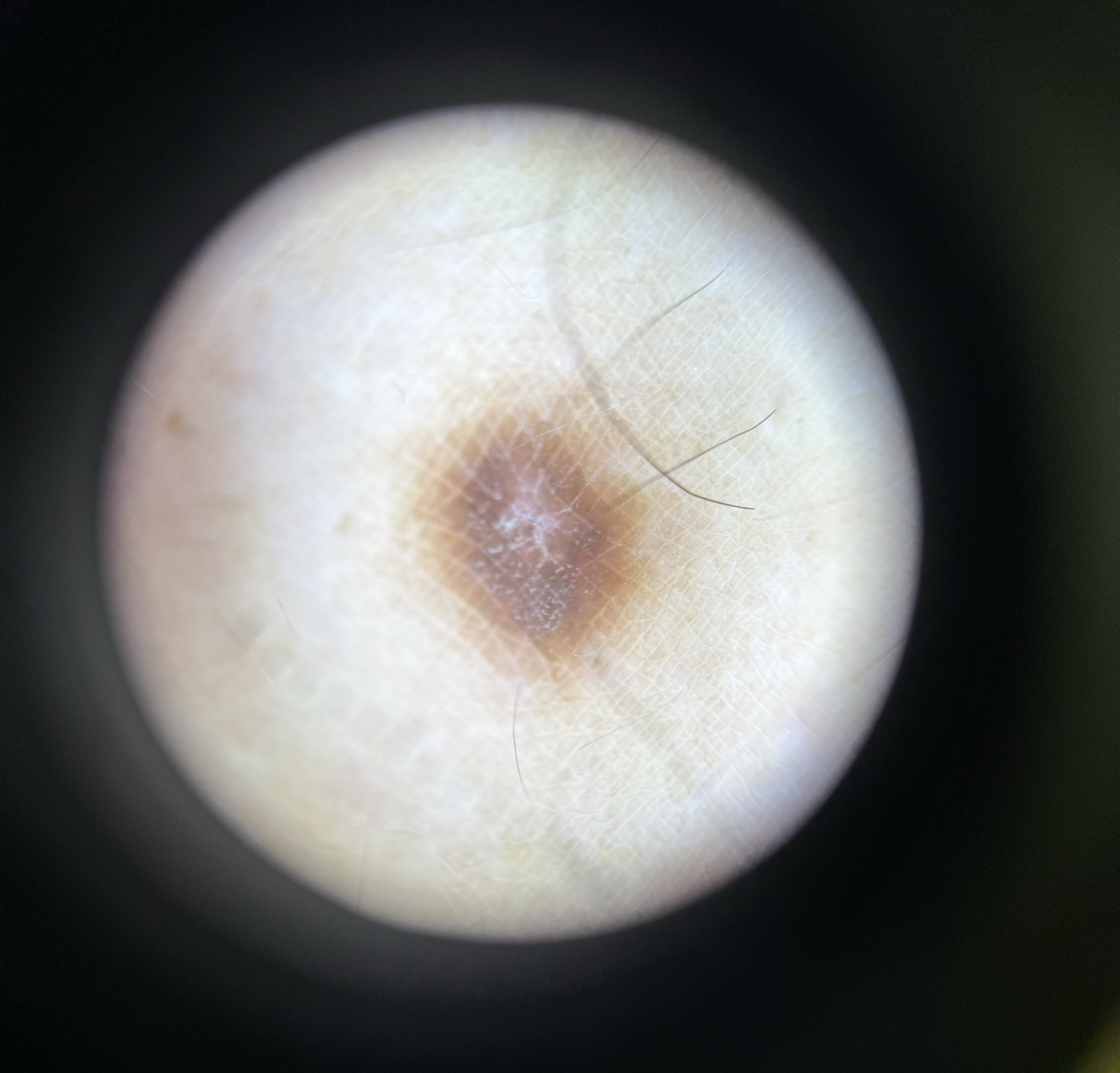 <p>Dermoscopic Image of a Dermatofibroma</p>