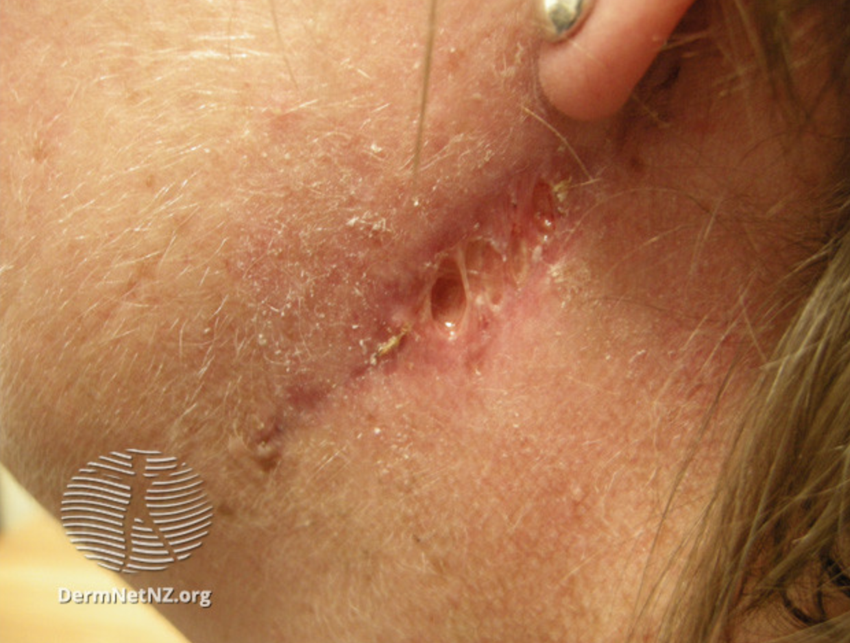 <p>Surgical Wound Dehiscence