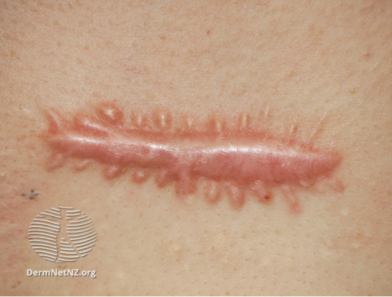 <p>Hypertrophic Scar Formation