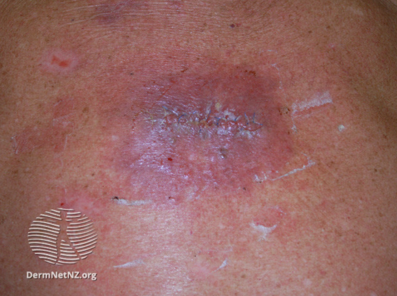 <p>Surgical Wound Infection