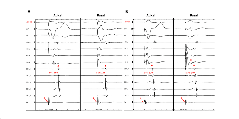 <p>Differential Ventricular Pacing Responses