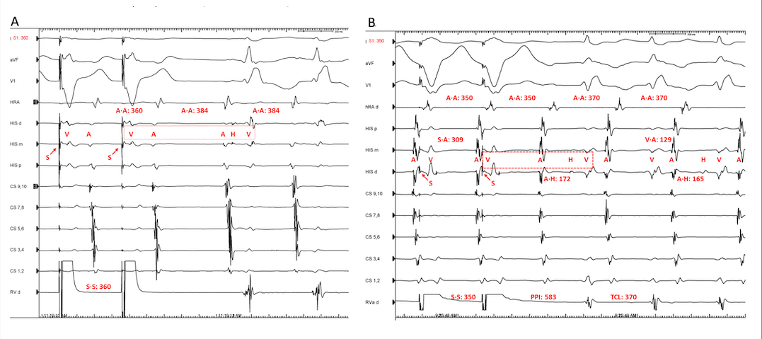 <p>Ventricular Overdrive Pacing Responses in Atrial Tachycardia