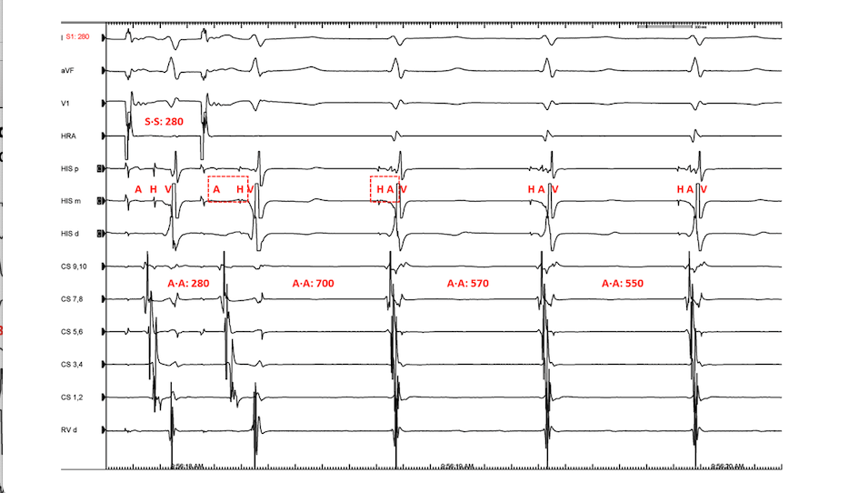 <p>Atrial Overdrive Pacing Response in Junctional Tachycardia