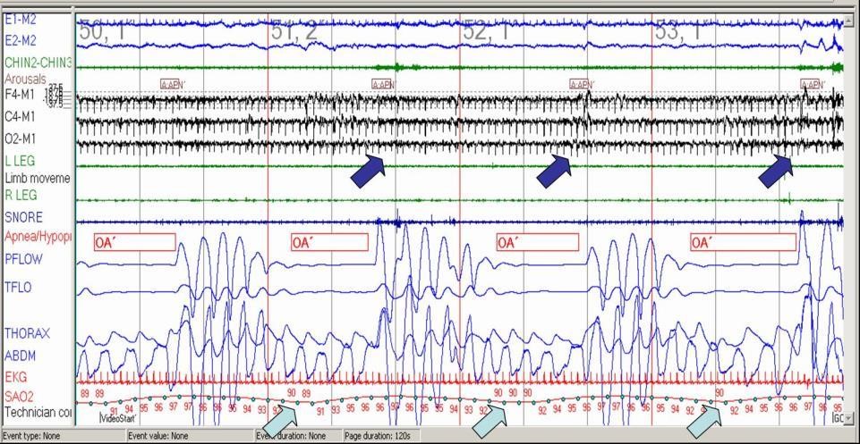 <p>Polysomnography, 120-Second Window Showing Obstructive Sleep Apnea