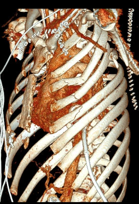 <p>Three-Dimensional&nbsp;Reconstruction of Flail Chest