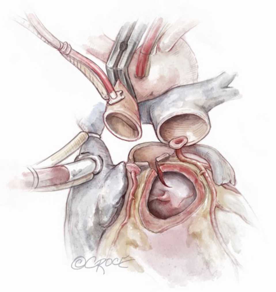 <p>Ross-Konno Procedure. This illustration depicts a Konno incision in the interventricular septum.</p>