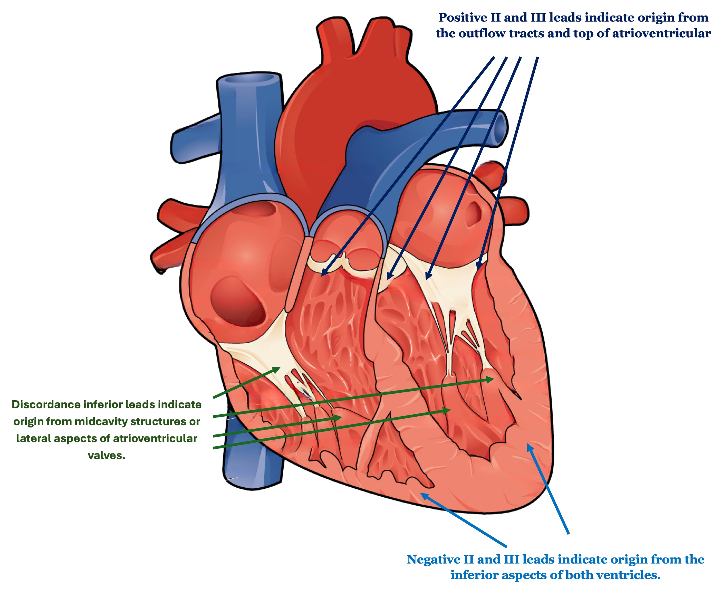 <p>Different Ventricular Tachycardia Origins