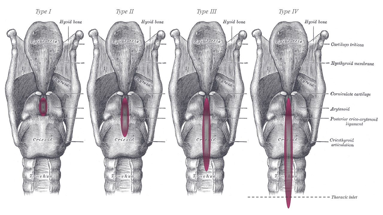 <p>Benjamin-Inglis Grading System for Laryngeal Clefts