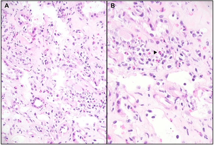 <p>Histopathology of Immune Checkpoint Inhibitor&ndash;Associated Interstitial Nephritis
