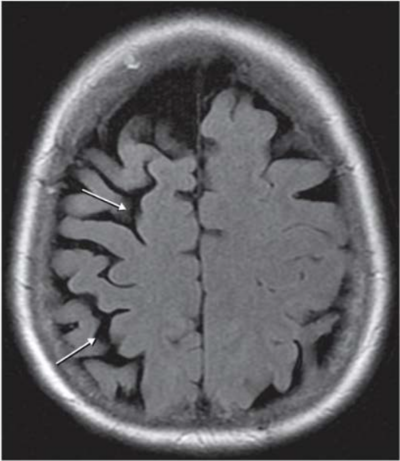 <p>Corticobasal Degeneration on Magnetic Resonance Imaging