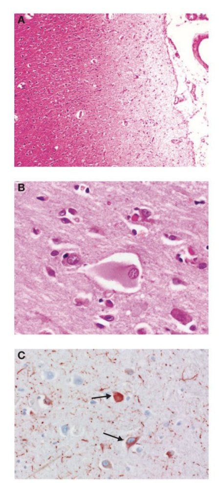 <p>Histopathologic Characteristics of Corticobasal Degeneration