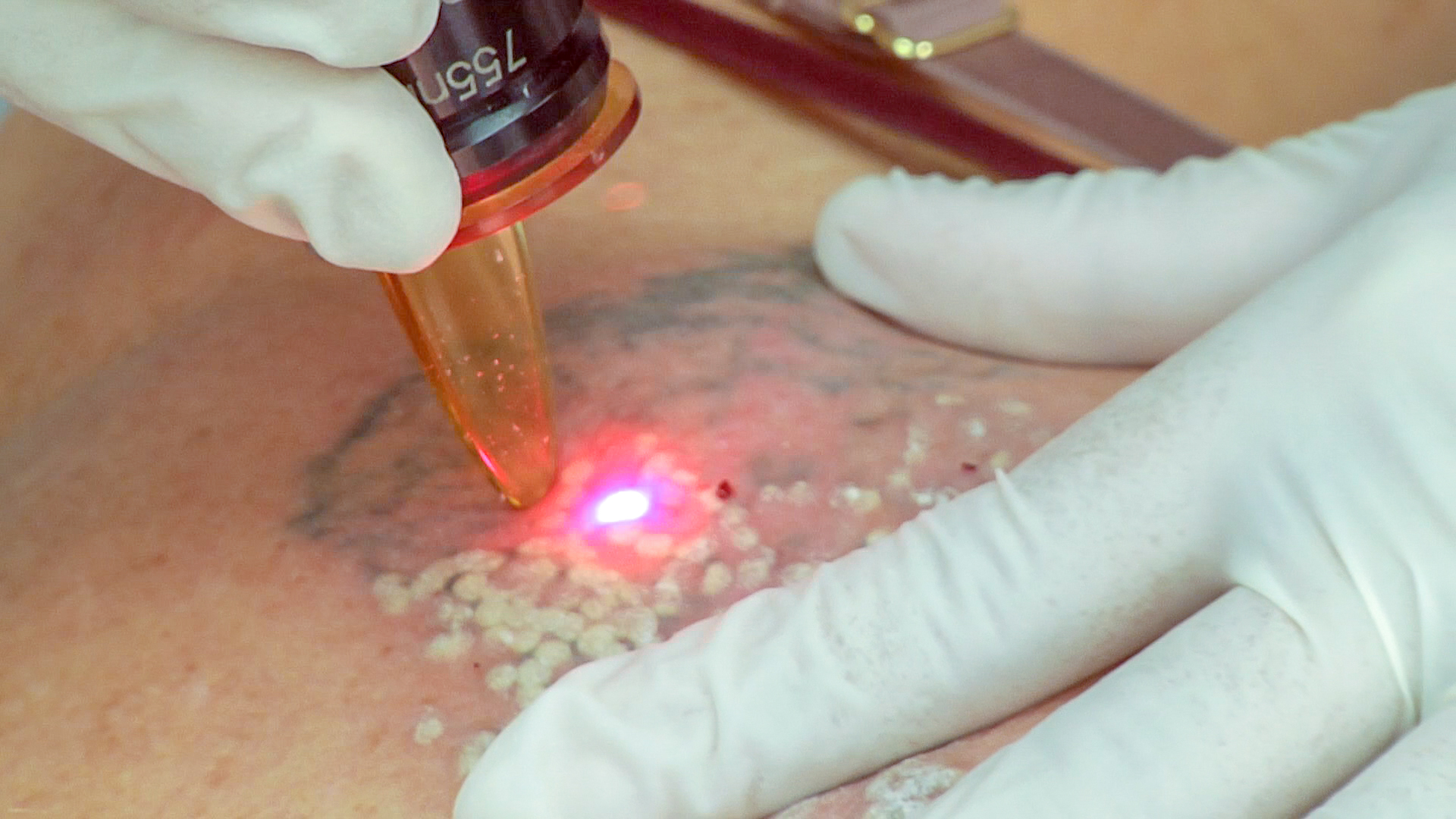 <p>Q-switched Alexandrite Laser