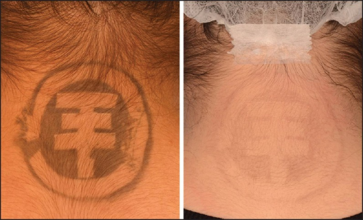 <p>Tattoo Removal, Before and After