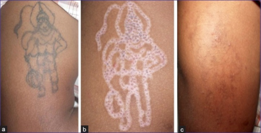 <p>R0 Protocol With Q-switched Nd:YAG Laser