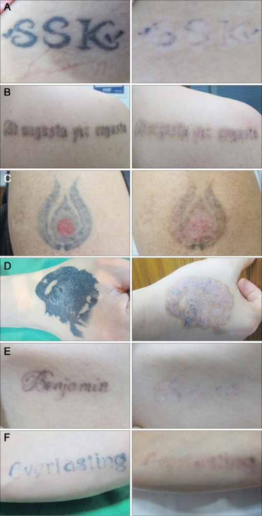 <p>Picosecond Alexandrite Tattoo Removal Results