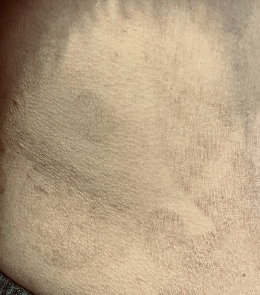 <p>Pityriasis Rotunda