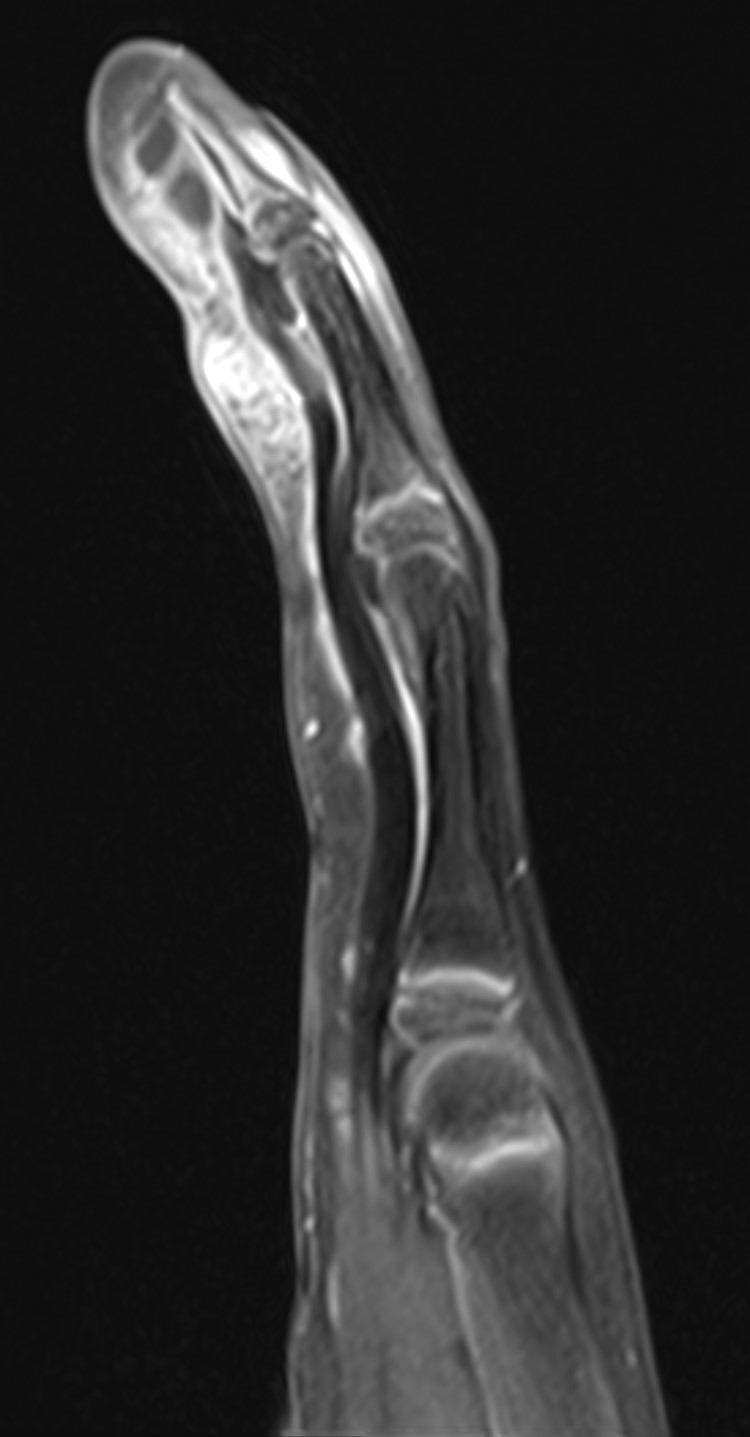 <p>Wound Infection