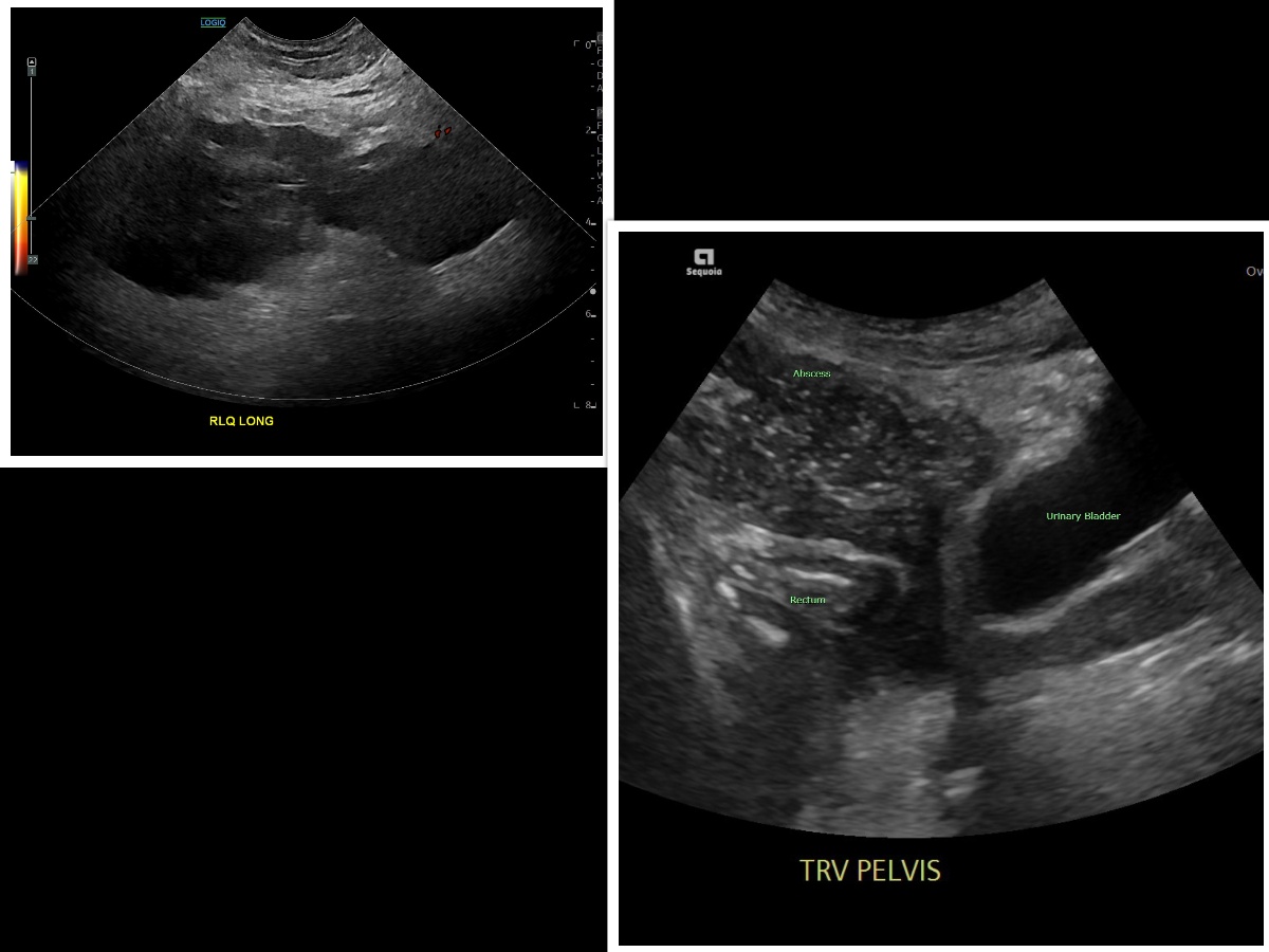 <p>Deep-Seated Abscess. US studies in 2 patients showed a well-loculated right lower quadrant and a perirectal abscess.</p>