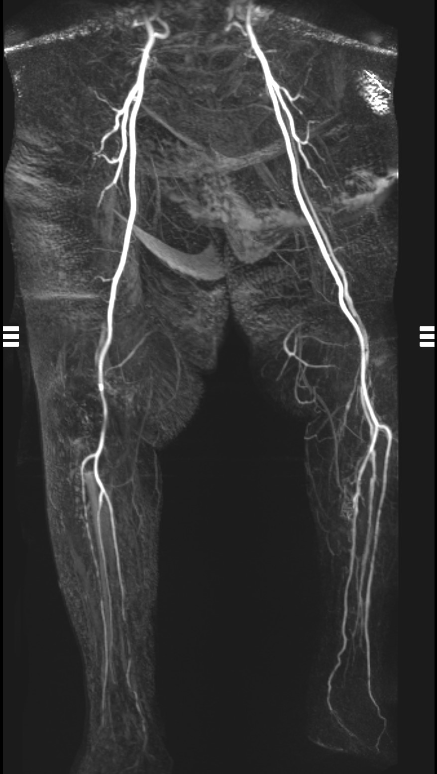 <p>Wound Imaging. Magnetic resonance angiography (MRA).</p>