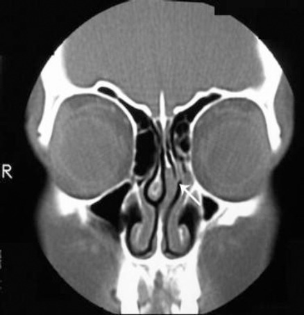 <p>Nasal Septal Fracture on Computed Tomography Without Contrast.</p>