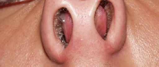 <p>Nasal Septal Hematoma in a Child