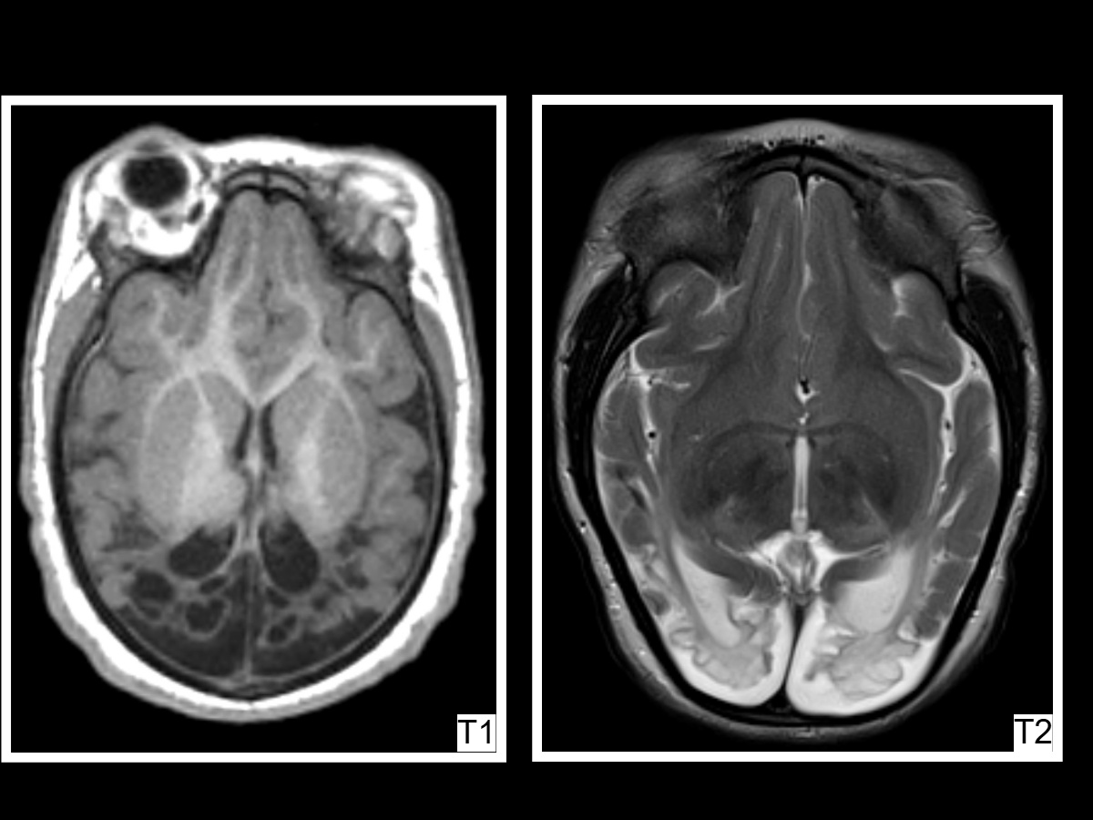 <p>Congenital Cytomegalovirus (CMV)