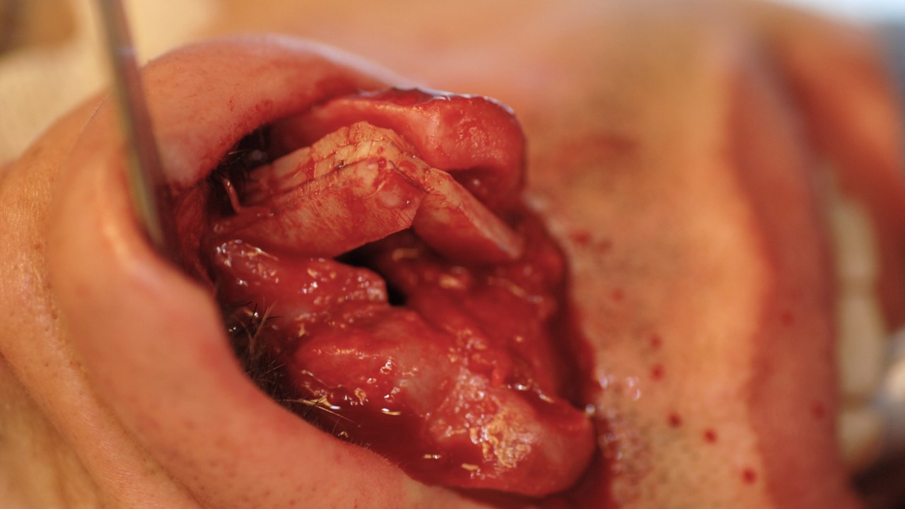 <p>Intraoperative View of Septal Reconstruction Using Costal Cartilage