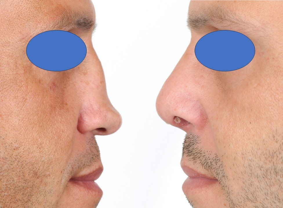 <p>Surgical Correction of Saddle Nose Deformity