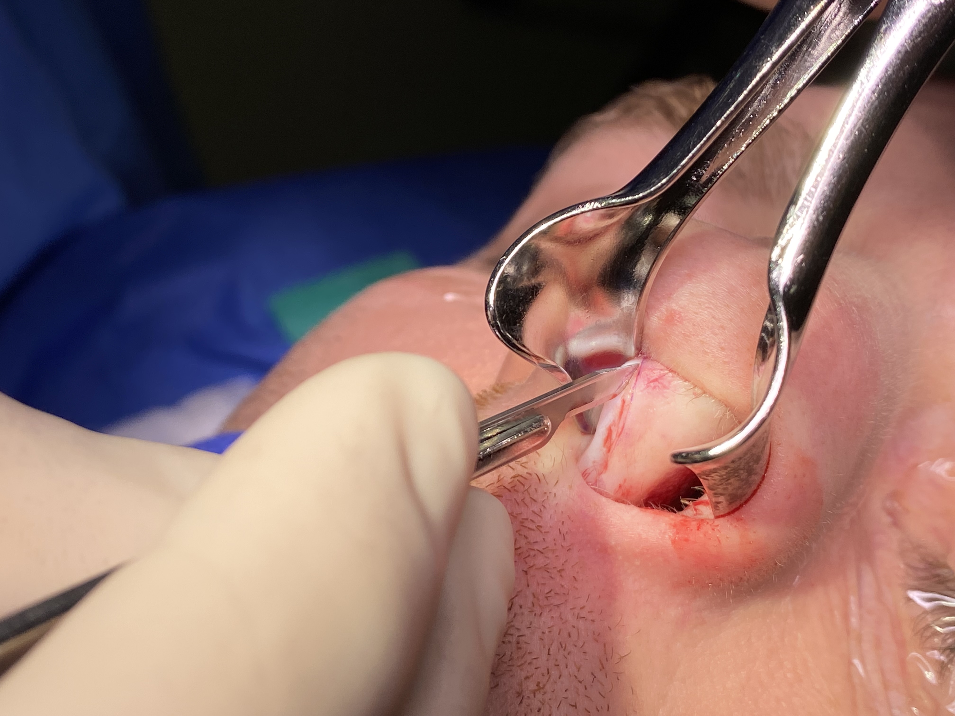 <p>Hemitransfixion Incision for Septoplasty.</p>