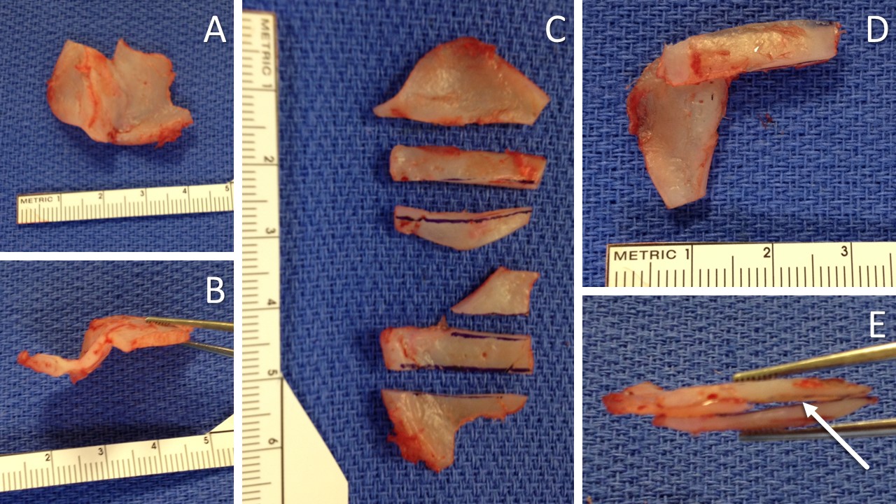 <p>Extracorporeal Septal Reconstruction Using Native Quadrangular Cartilage