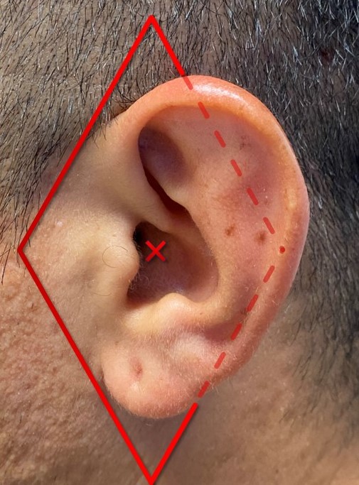 <p>Diamond Auricular Block