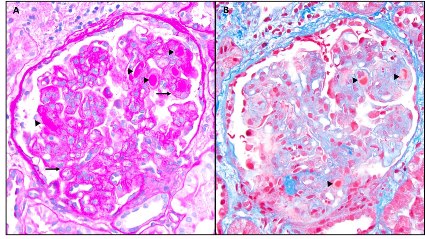 <p>Membranoproliferative Pattern of Injury: PSA and Trichrome Stains